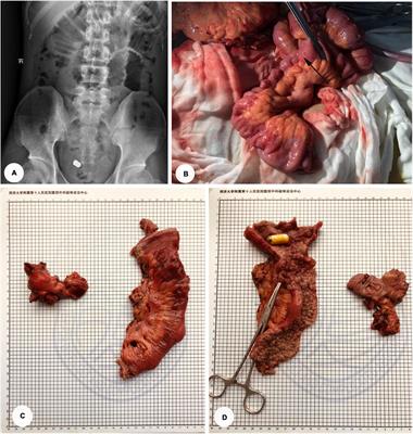 Crohn’s Disease Complicated by Rare Types of Intestinal Obstruction: Two Case Reports